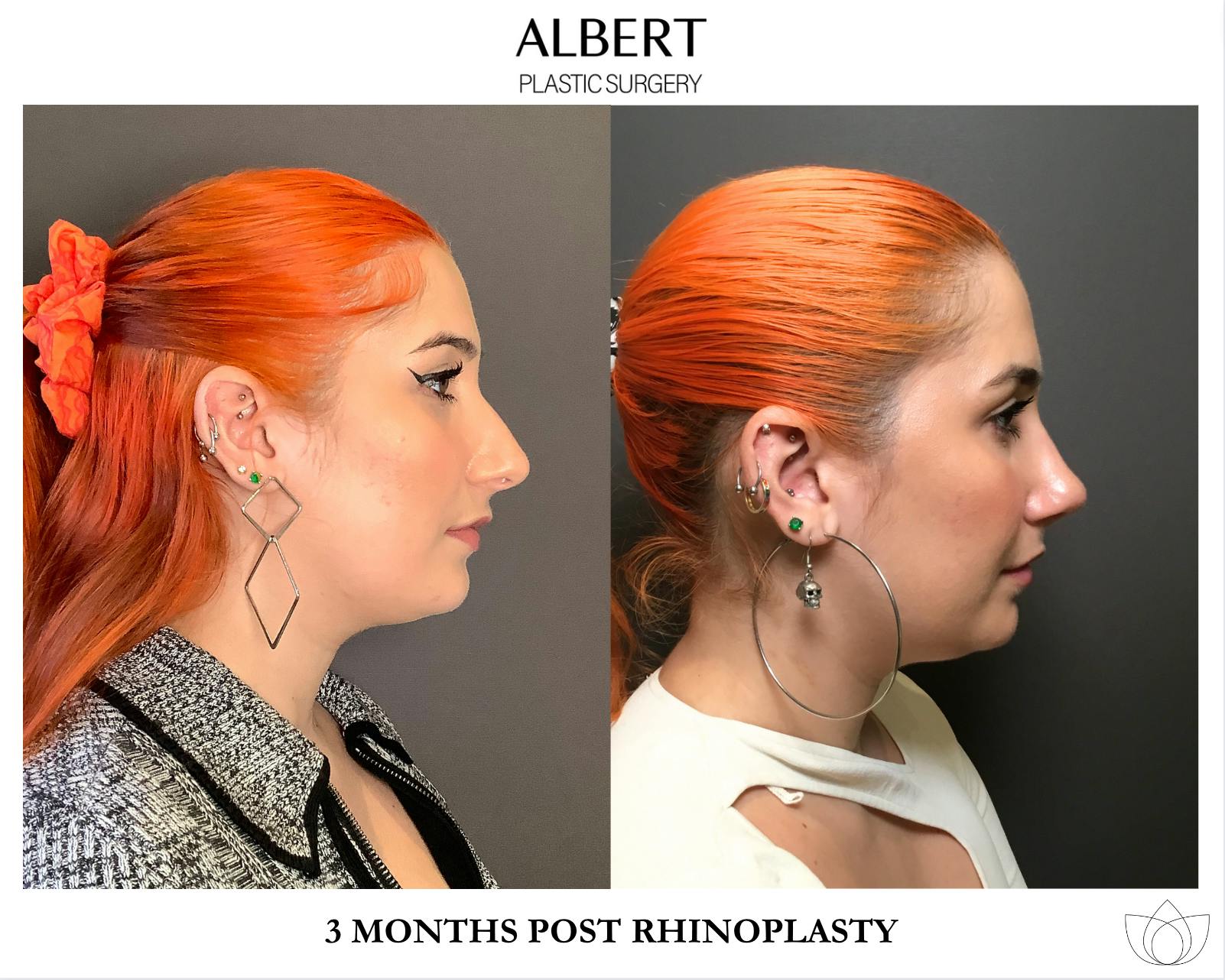 Rhinoplasty Before & After Gallery - Patient 143120 - Image 1