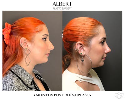 Rhinoplasty Before & After Gallery - Patient 143120 - Image 1