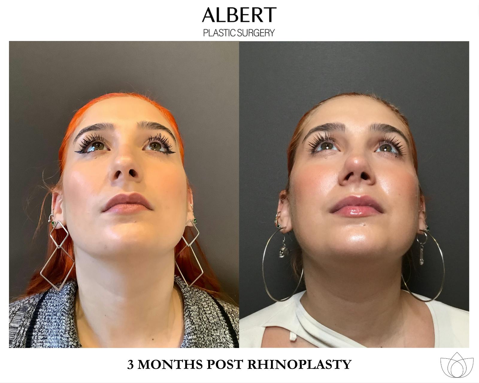 Rhinoplasty Before & After Gallery - Patient 143120 - Image 6