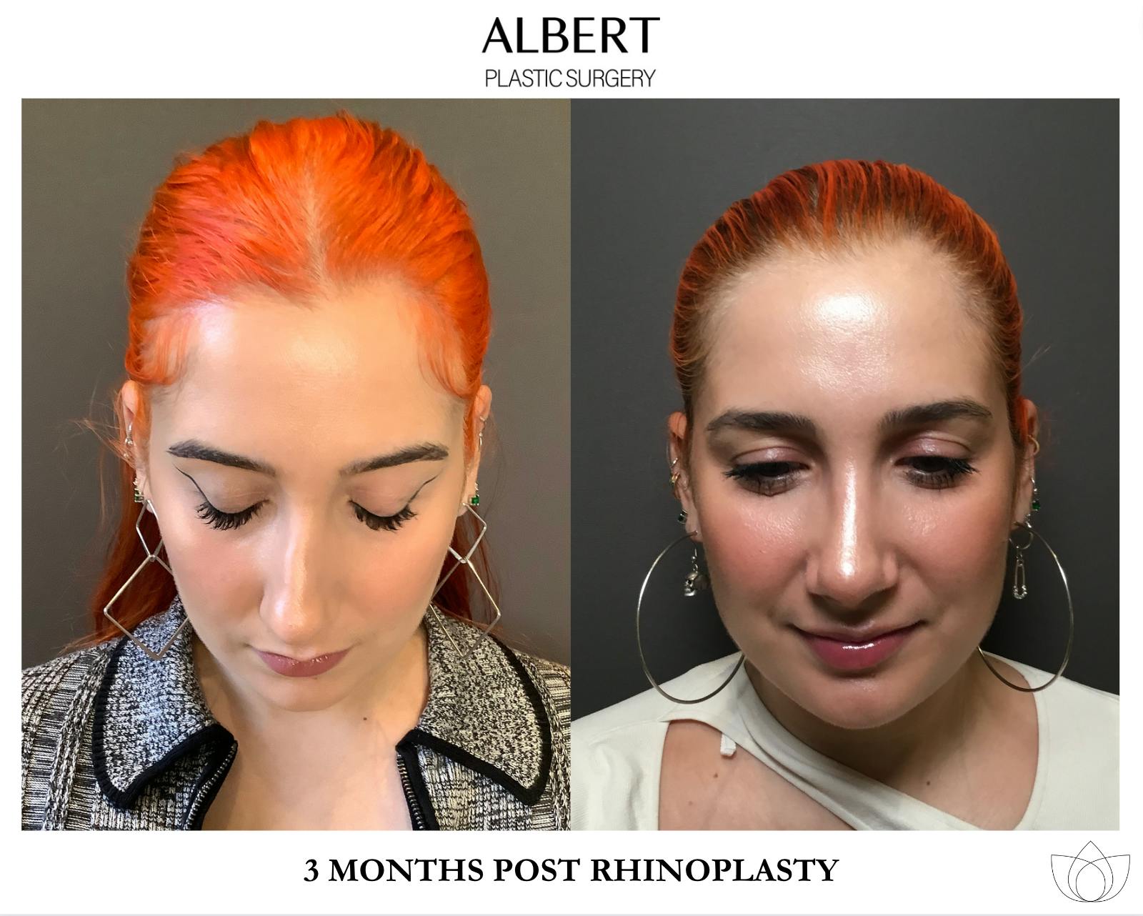 Rhinoplasty Before & After Gallery - Patient 143120 - Image 7