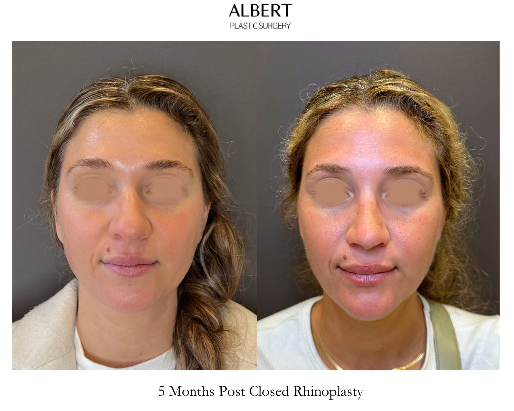 Rhinoplasty Before & After Gallery - Patient 211648 - Image 3