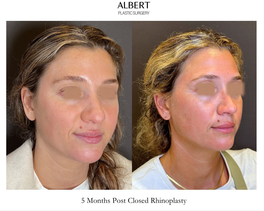 Rhinoplasty Before & After Gallery - Patient 211648 - Image 2
