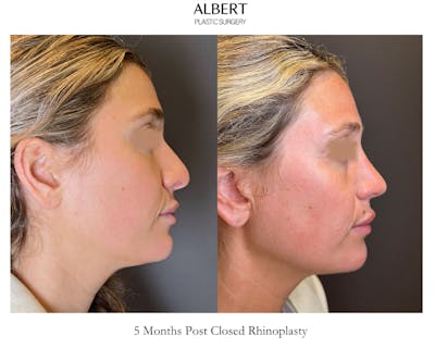Rhinoplasty Before & After Gallery - Patient 211648 - Image 1