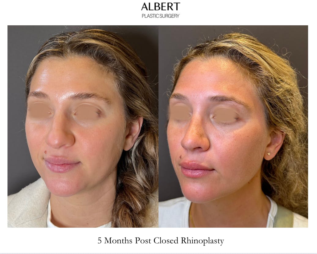 Rhinoplasty Before & After Gallery - Patient 211648 - Image 4