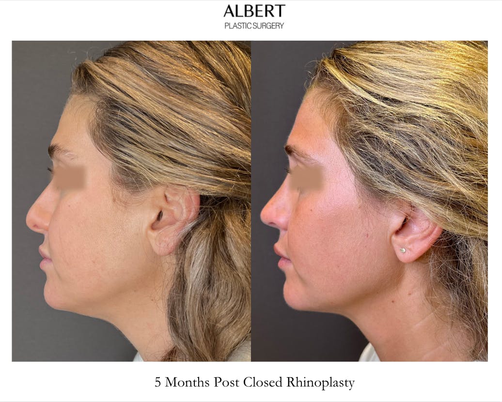 Rhinoplasty Before & After Gallery - Patient 211648 - Image 5