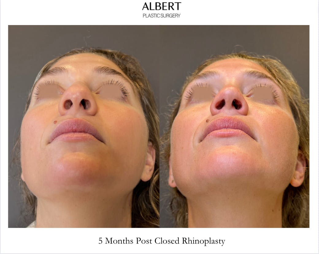 Rhinoplasty Before & After Gallery - Patient 211648 - Image 6