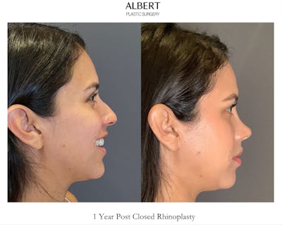Rhinoplasty Before & After Gallery - Patient 139164 - Image 1