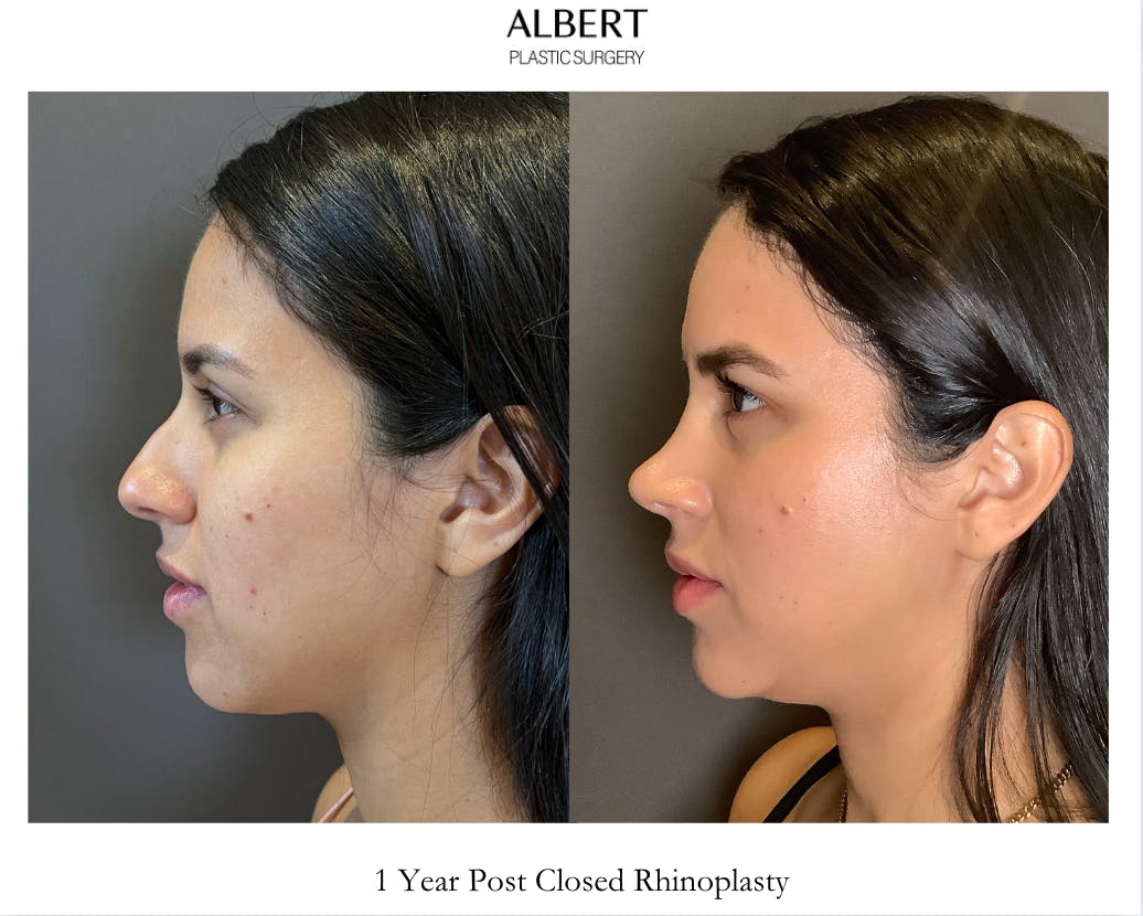 Rhinoplasty Before & After Gallery - Patient 139164 - Image 2