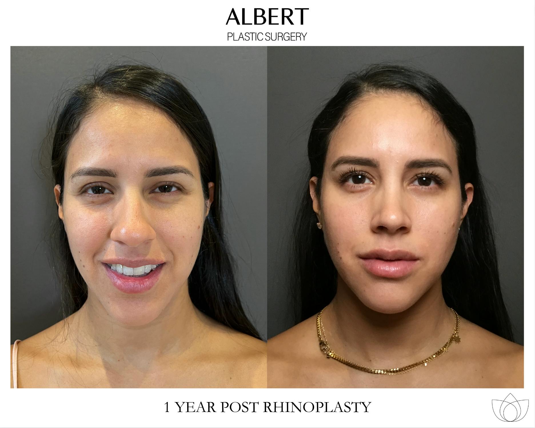 Rhinoplasty Before & After Gallery - Patient 139164 - Image 3
