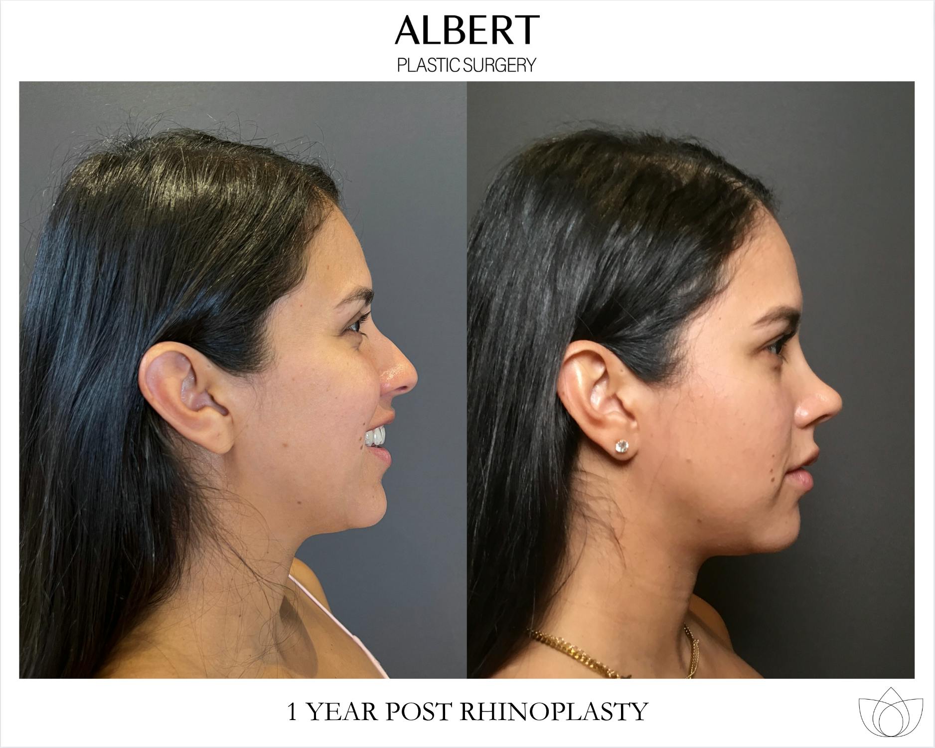 Rhinoplasty Before & After Gallery - Patient 139164 - Image 4