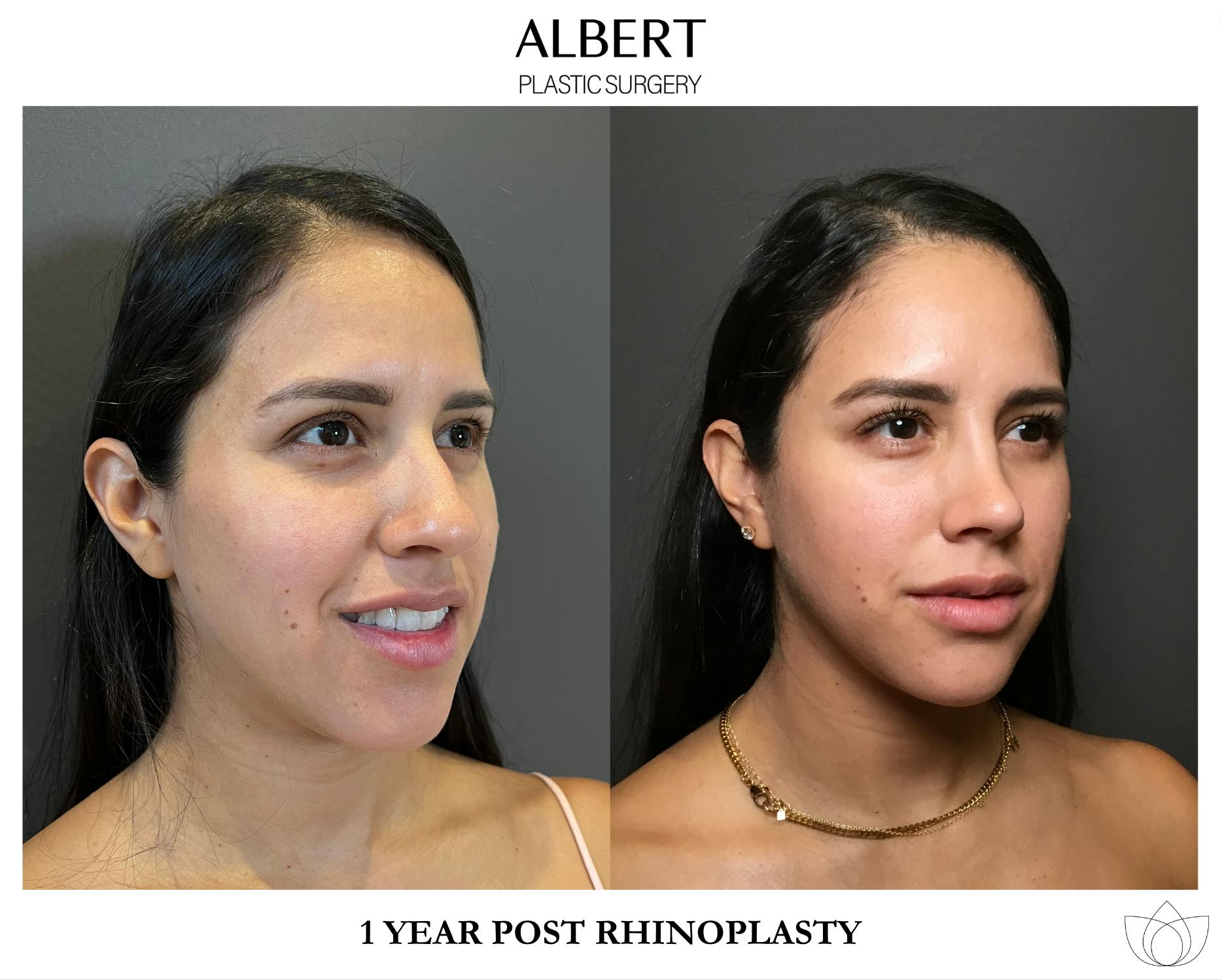 Rhinoplasty Before & After Gallery - Patient 139164 - Image 5