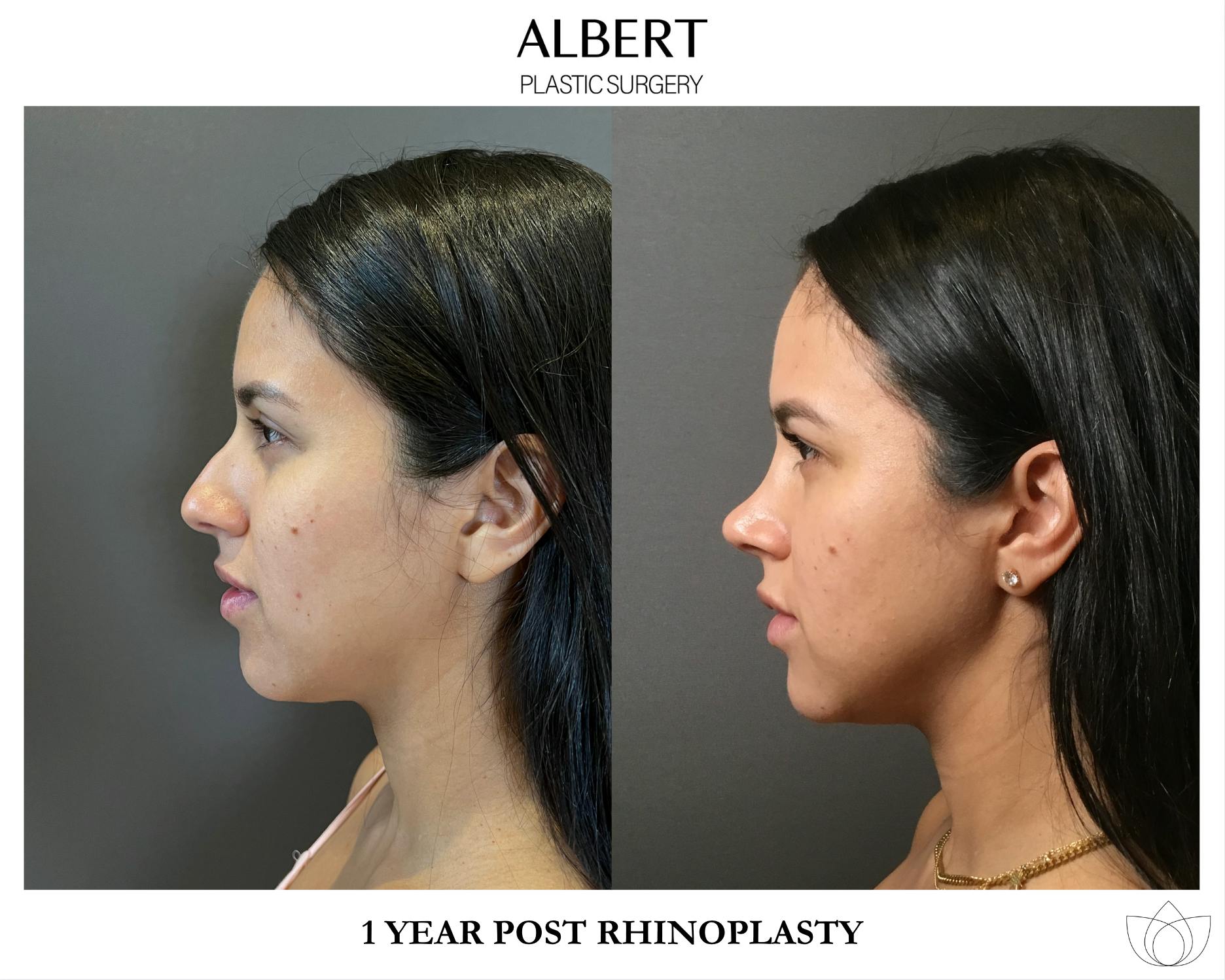 Rhinoplasty Before & After Gallery - Patient 139164 - Image 6