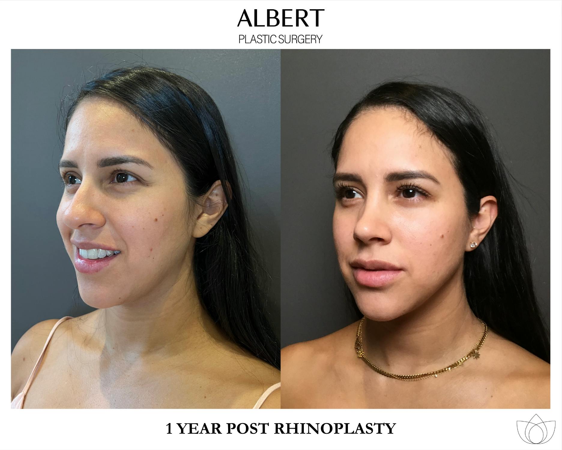 Rhinoplasty Before & After Gallery - Patient 139164 - Image 7