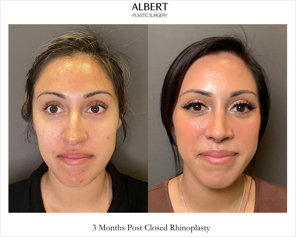 Rhinoplasty Before & After Gallery - Patient 291796 - Image 3