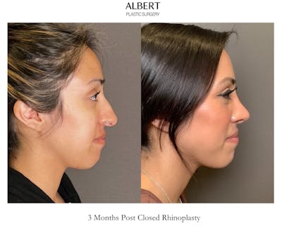 Rhinoplasty Before & After Gallery - Patient 291796 - Image 1