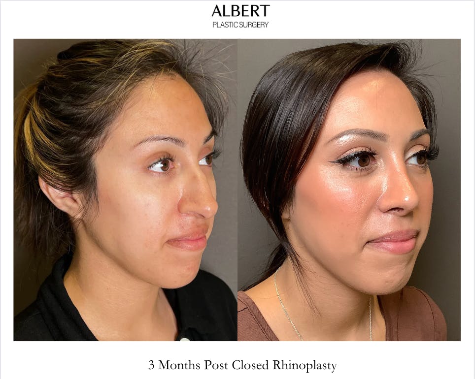 Rhinoplasty Before & After Gallery - Patient 291796 - Image 2