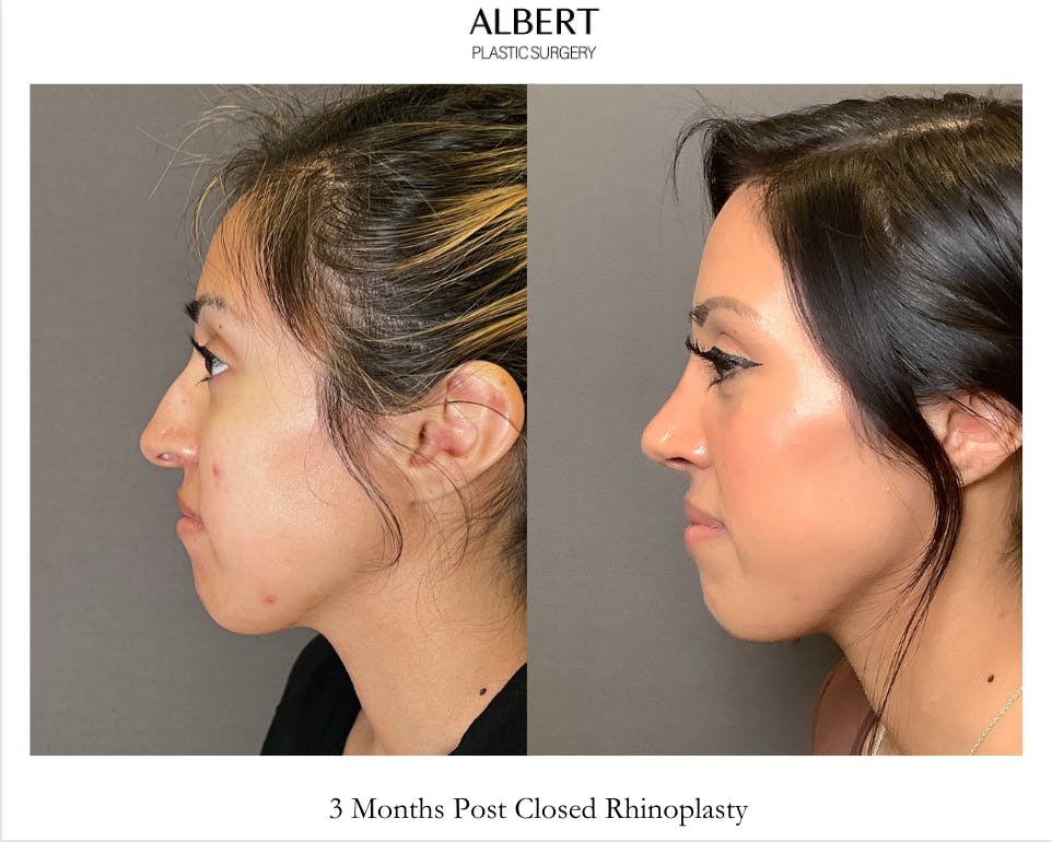 Rhinoplasty Before & After Gallery - Patient 291796 - Image 4