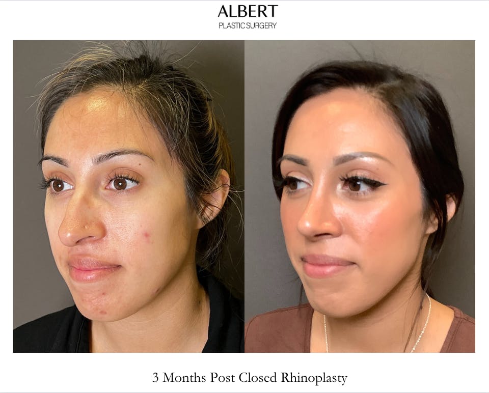 Rhinoplasty Before & After Gallery - Patient 291796 - Image 5
