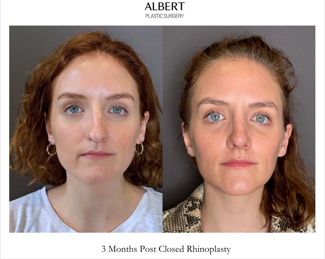 Rhinoplasty Before & After Gallery - Patient 352072 - Image 2