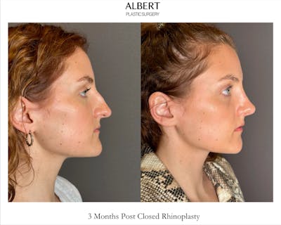 Rhinoplasty Before & After Gallery - Patient 352072 - Image 1
