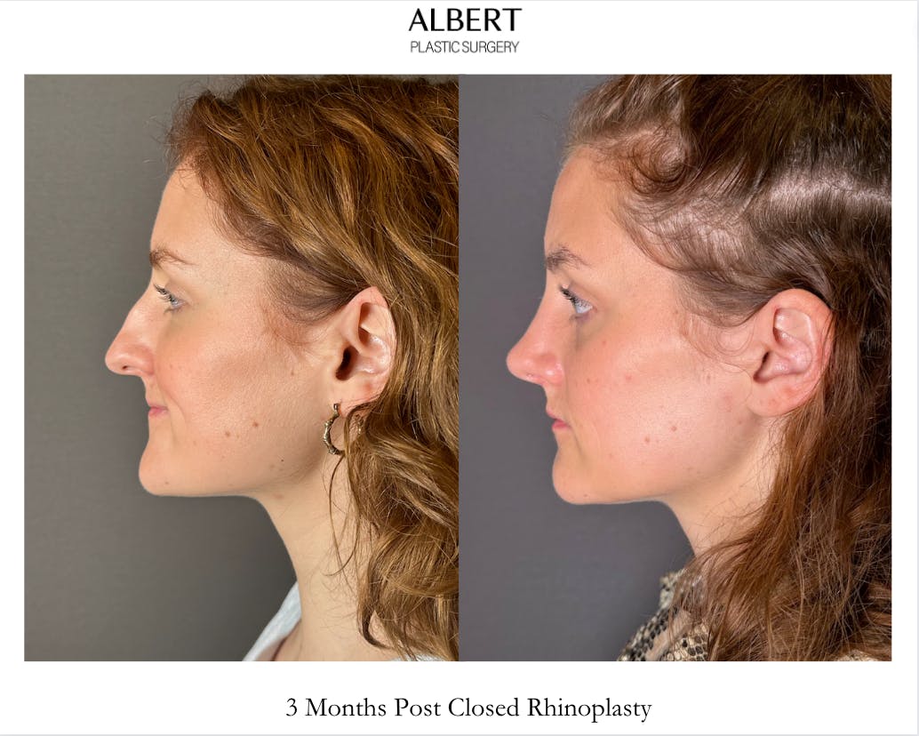 Rhinoplasty Before & After Gallery - Patient 352072 - Image 3