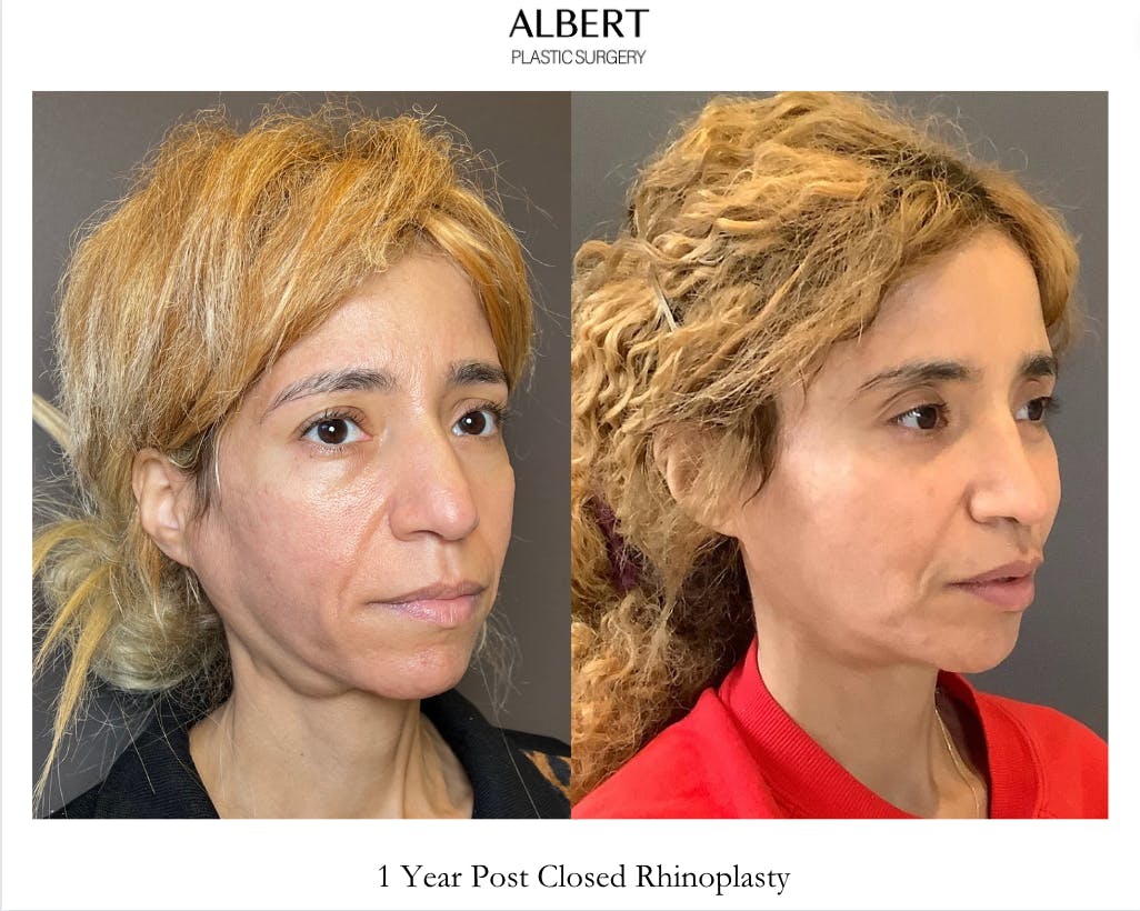 Rhinoplasty Before & After Gallery - Patient 288614 - Image 2