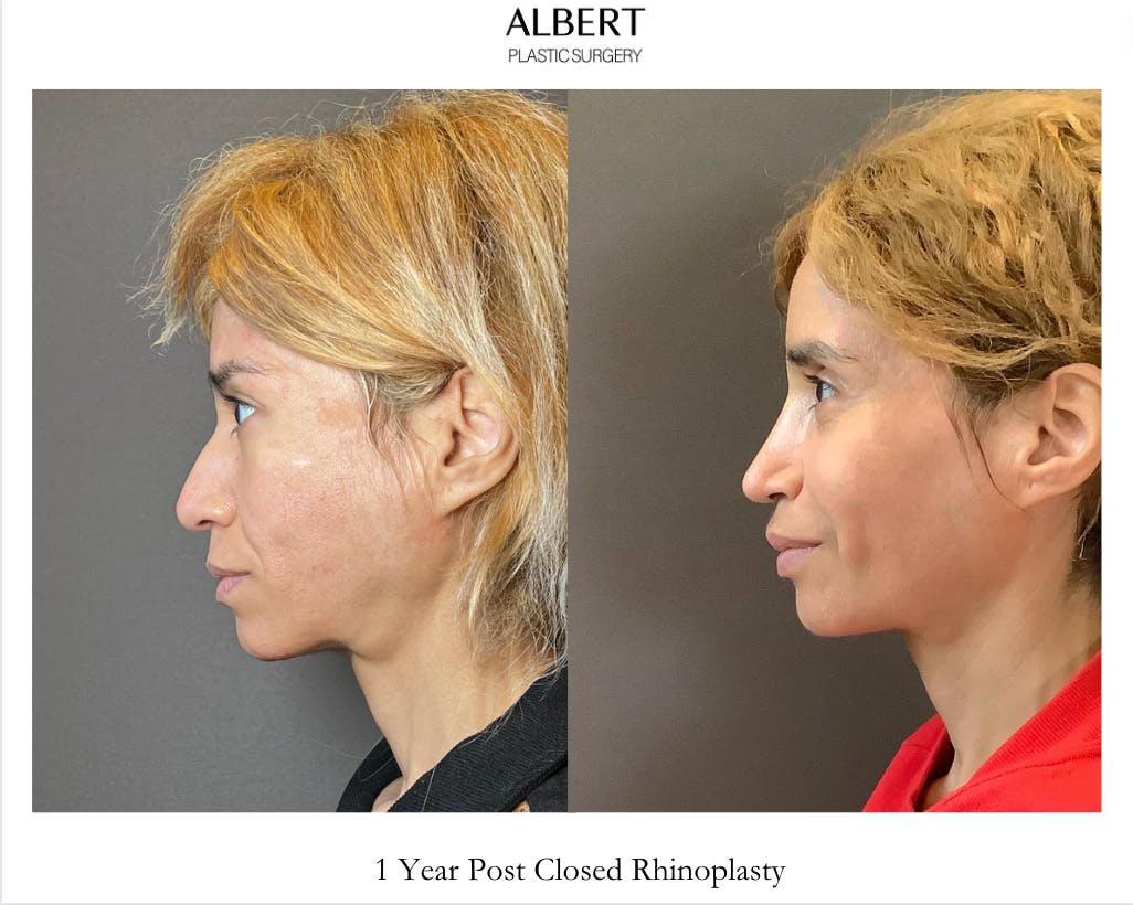 Rhinoplasty Before & After Gallery - Patient 288614 - Image 4