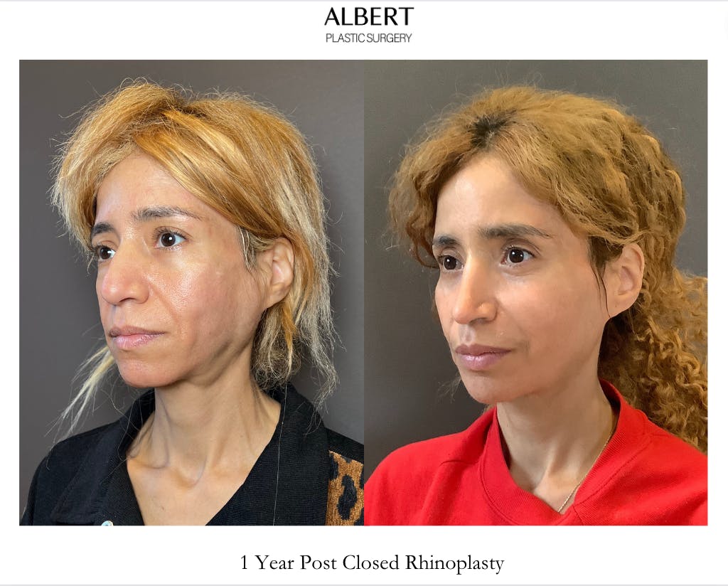 Rhinoplasty Before & After Gallery - Patient 288614 - Image 5