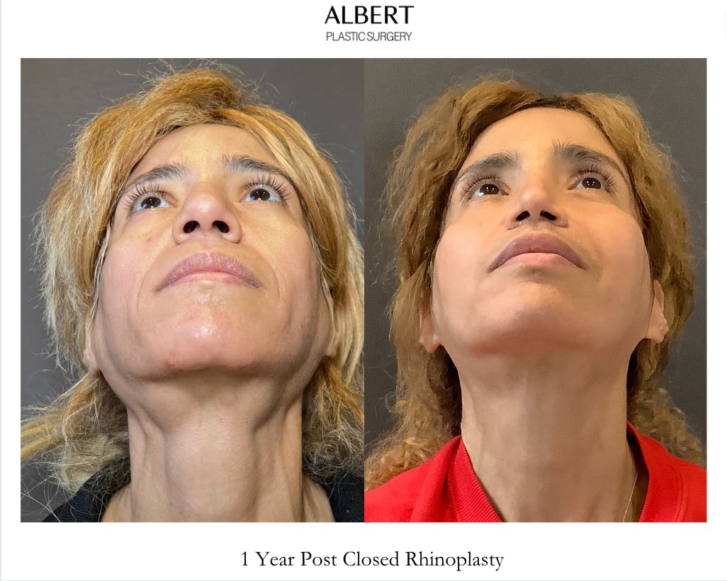 Rhinoplasty Before & After Gallery - Patient 288614 - Image 6