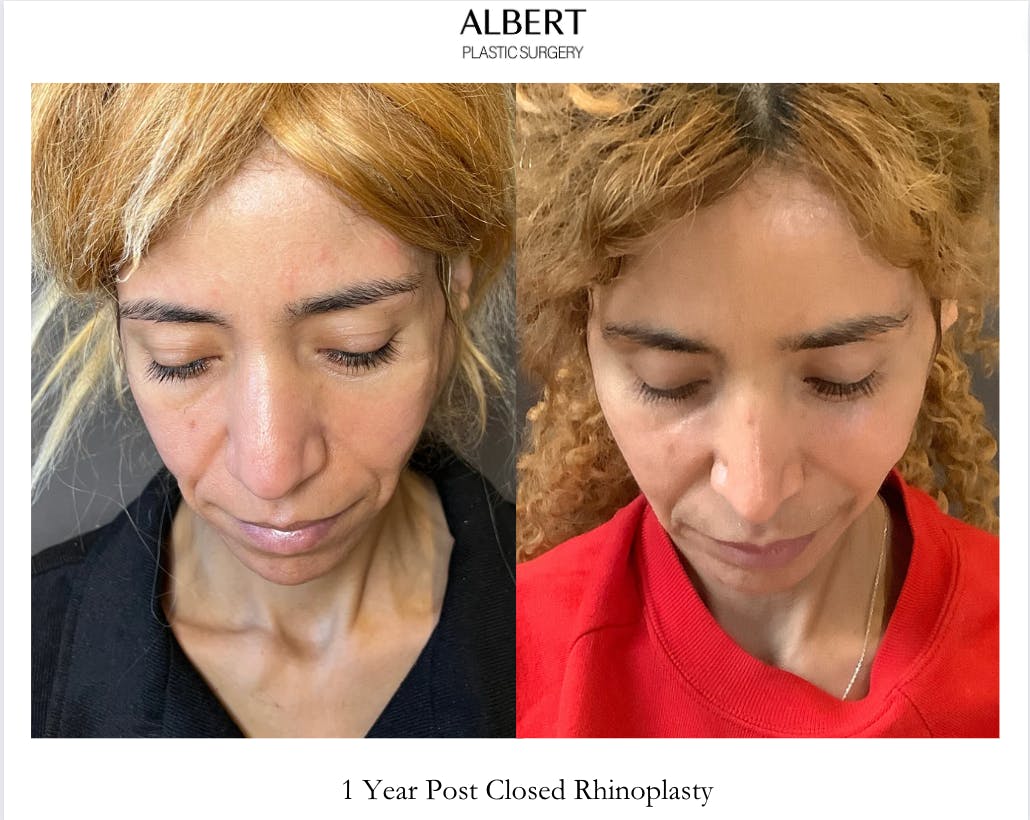 Rhinoplasty Before & After Gallery - Patient 288614 - Image 7