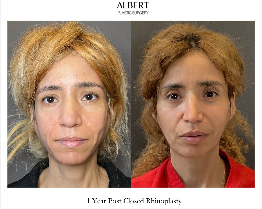 Rhinoplasty Before & After Gallery - Patient 288614 - Image 3