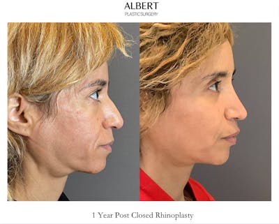 Rhinoplasty Before & After Gallery - Patient 288614 - Image 1