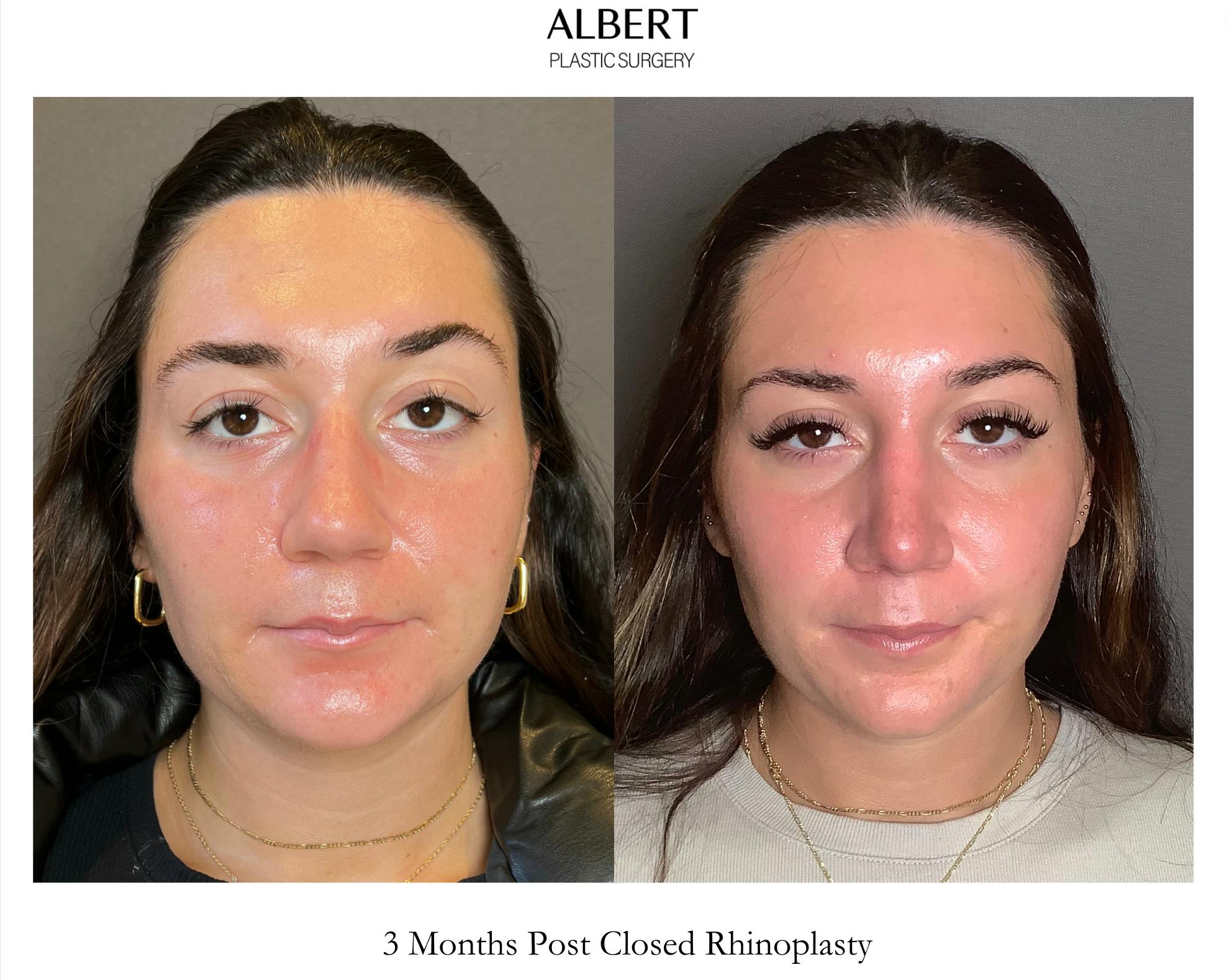 Rhinoplasty Before & After Gallery - Patient 140797 - Image 3
