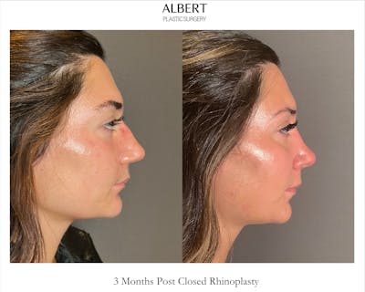 Rhinoplasty Before & After Gallery - Patient 140797 - Image 1
