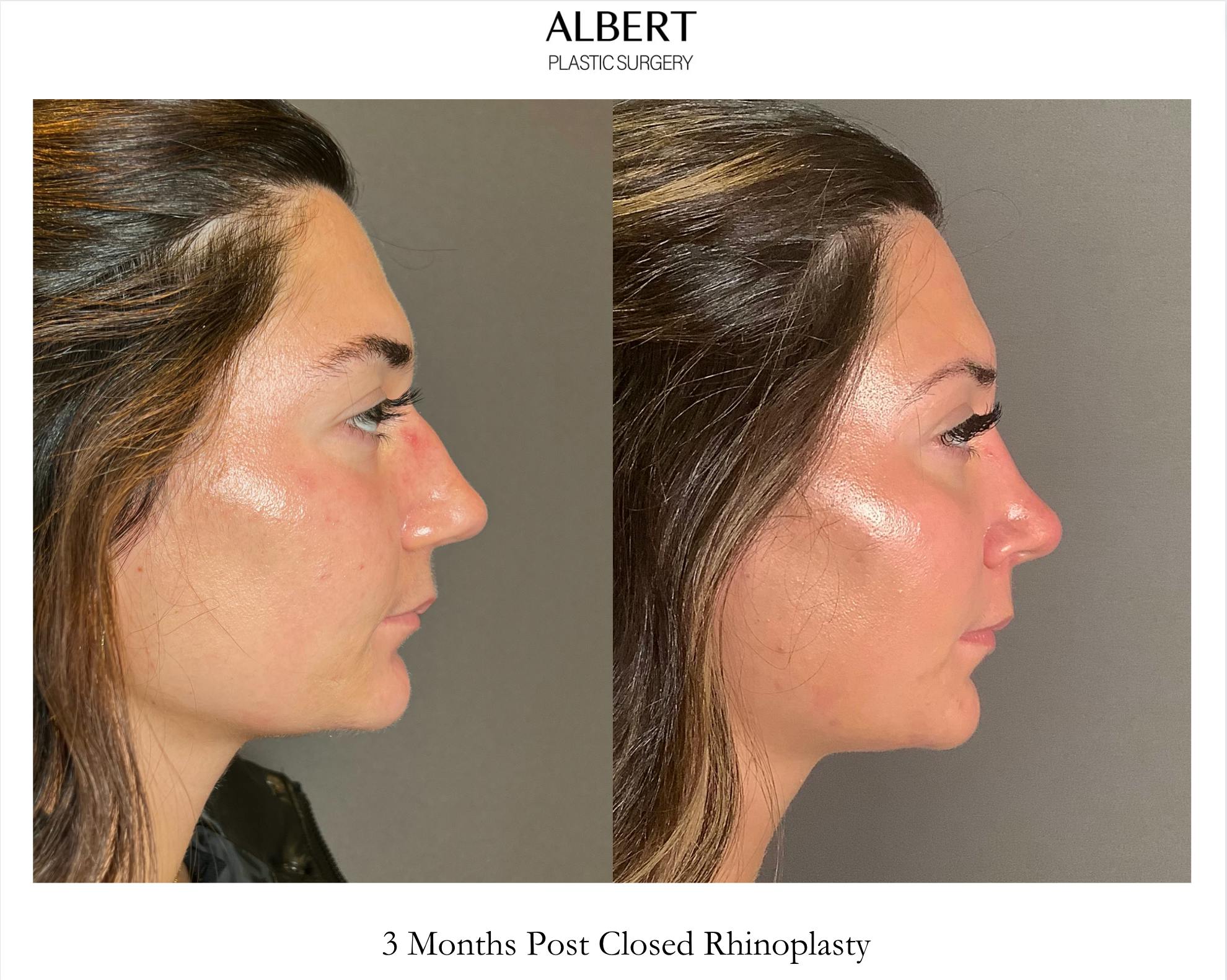Rhinoplasty Before & After Gallery - Patient 140797 - Image 1