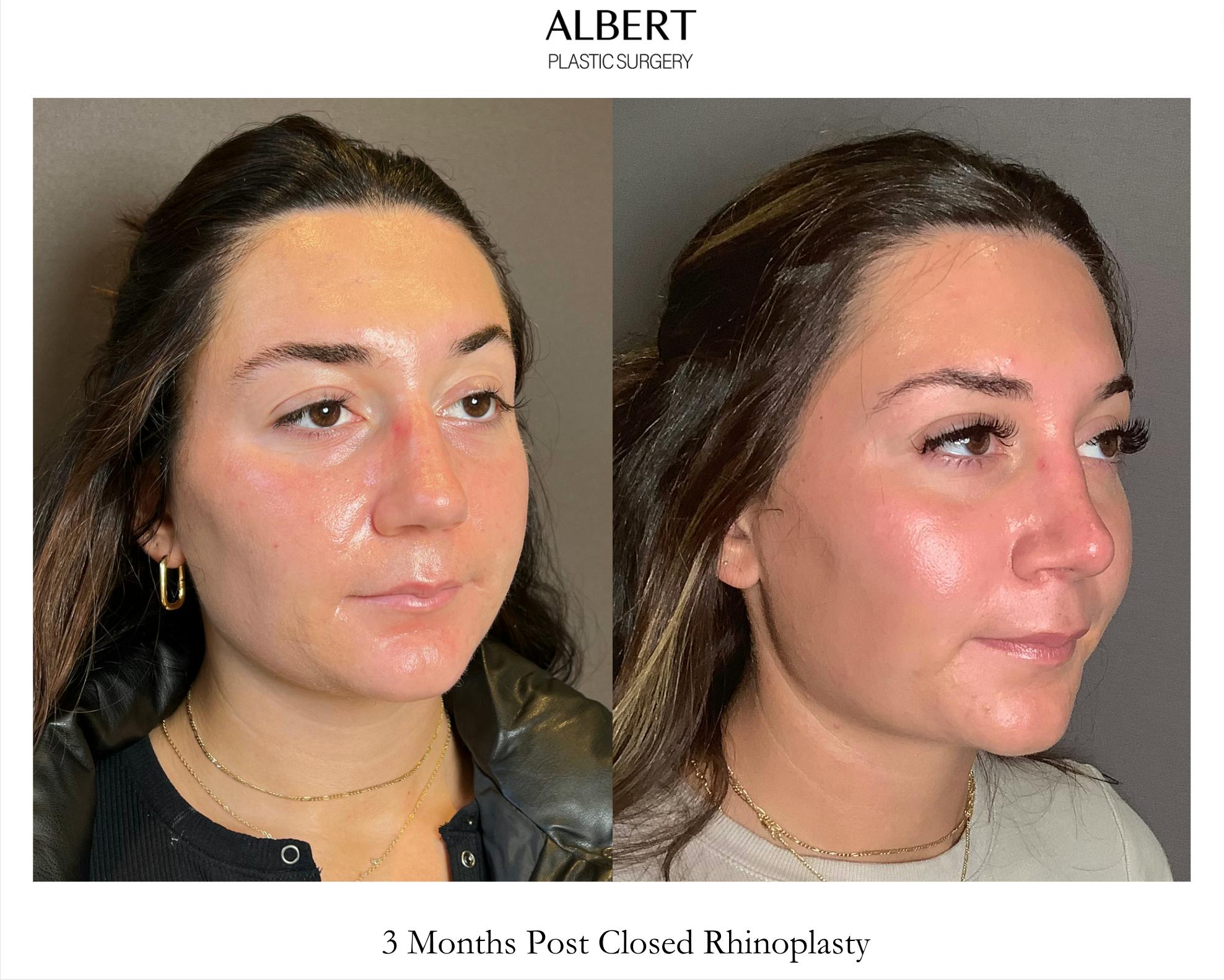Rhinoplasty Before & After Gallery - Patient 140797 - Image 2