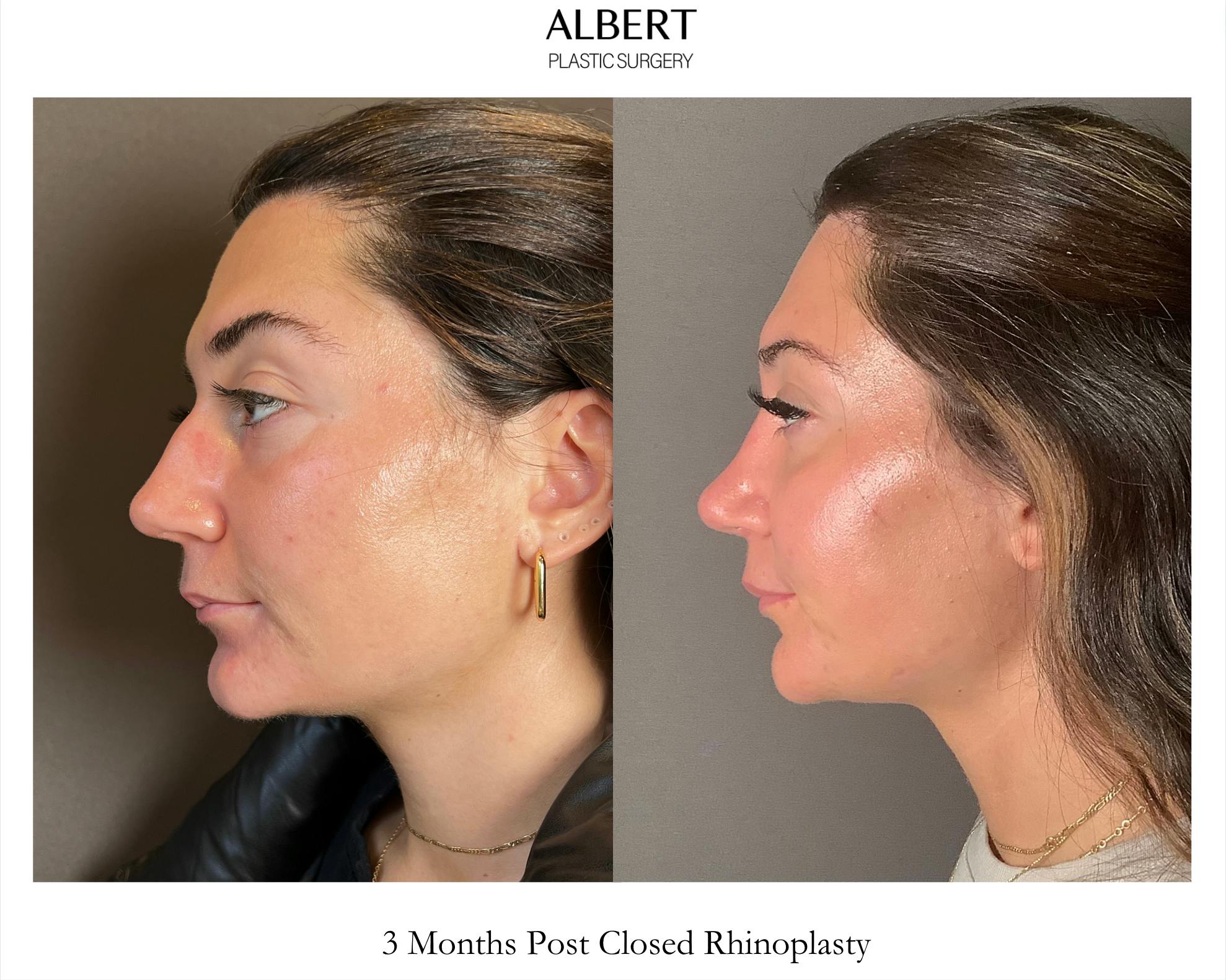 Rhinoplasty Before & After Gallery - Patient 140797 - Image 4