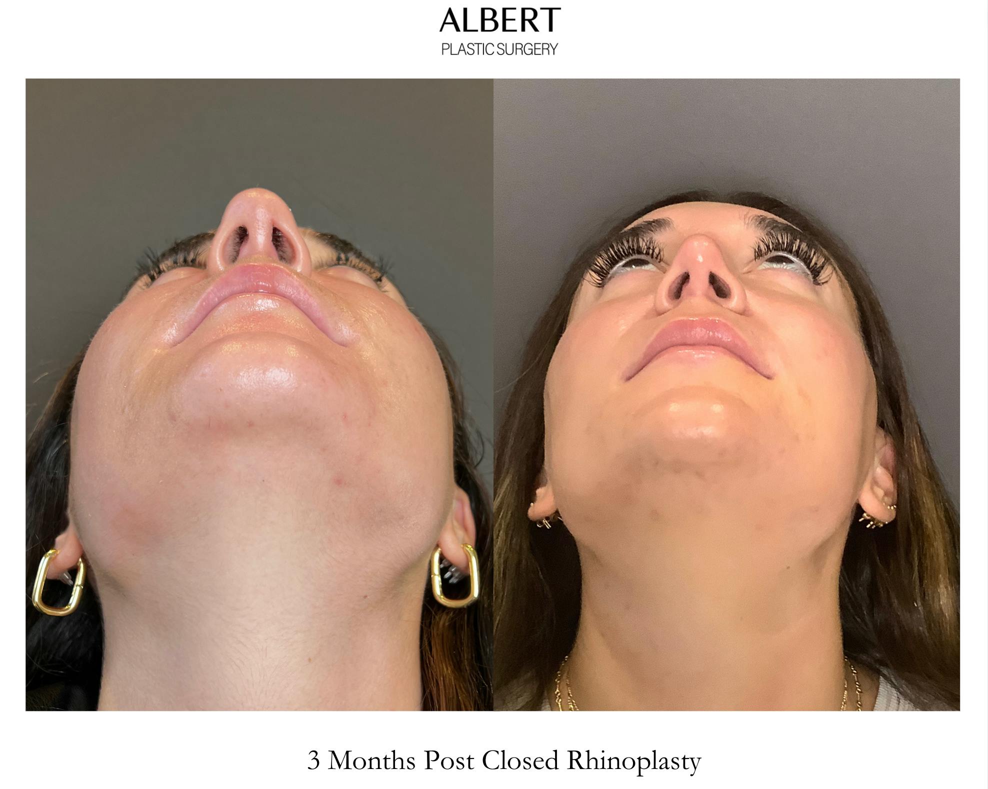 Rhinoplasty Before & After Gallery - Patient 140797 - Image 5