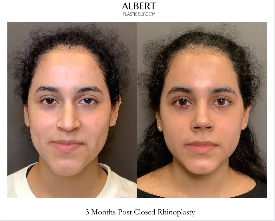 Rhinoplasty Before & After Gallery - Patient 320671 - Image 3