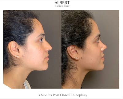 Rhinoplasty Before & After Gallery - Patient 320671 - Image 1