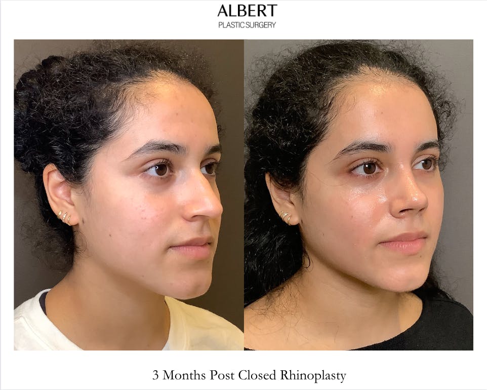 Rhinoplasty Before & After Gallery - Patient 320671 - Image 2