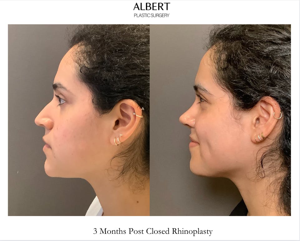 Rhinoplasty Before & After Gallery - Patient 320671 - Image 4