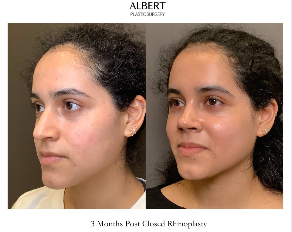 Rhinoplasty Before & After Gallery - Patient 320671 - Image 5