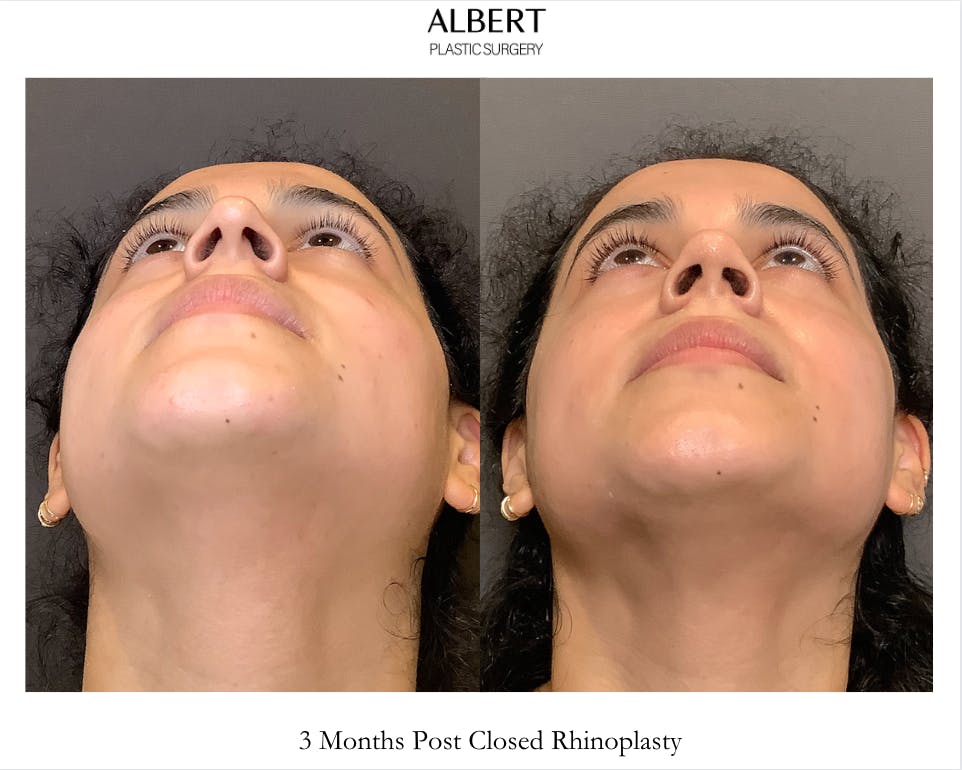 Rhinoplasty Before & After Gallery - Patient 320671 - Image 6