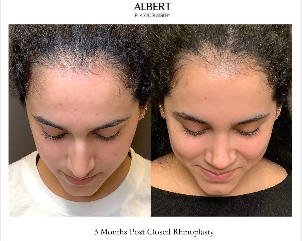 Rhinoplasty Before & After Gallery - Patient 320671 - Image 7