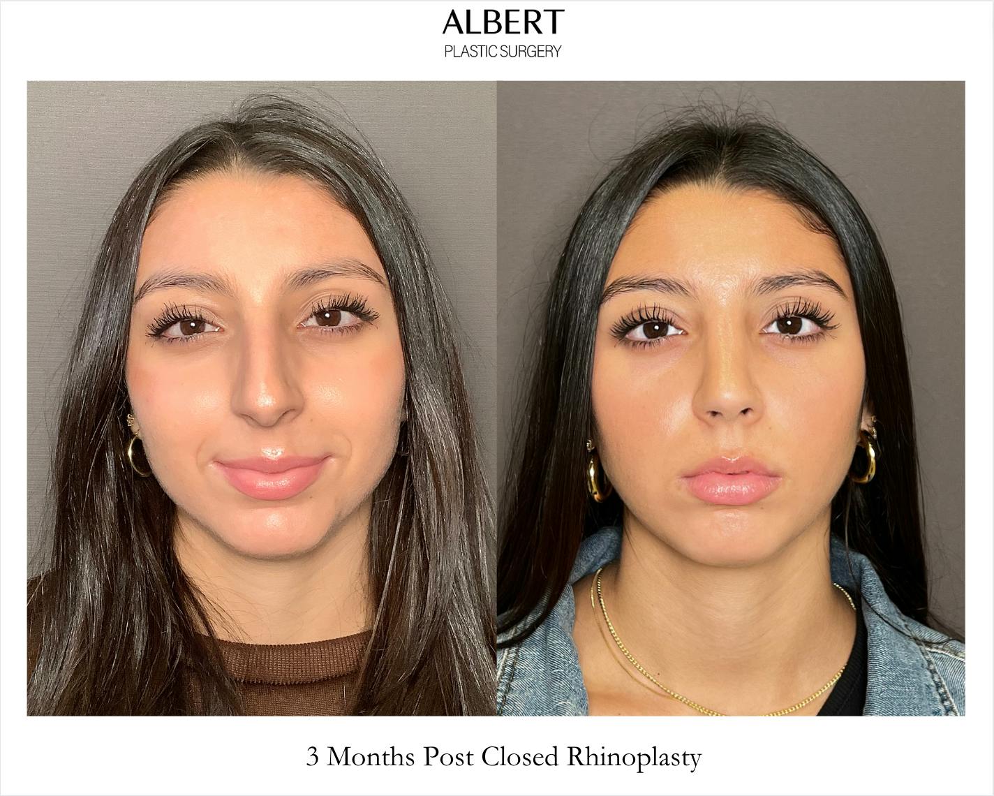 Rhinoplasty Before & After Gallery - Patient 393874 - Image 3
