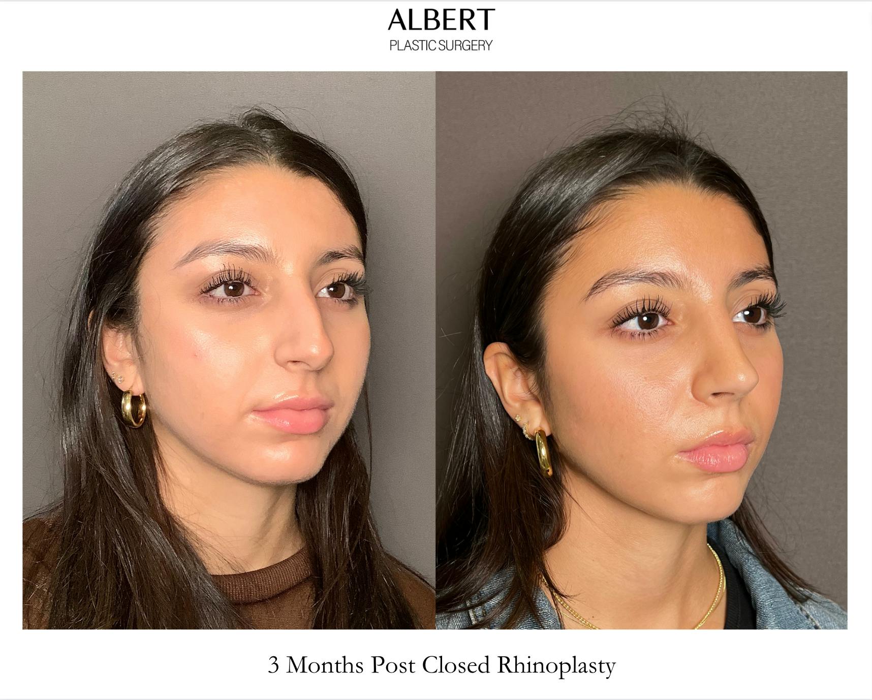 Rhinoplasty Before & After Gallery - Patient 393874 - Image 2
