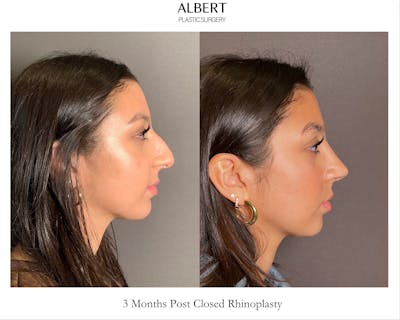 Rhinoplasty Before & After Gallery - Patient 393874 - Image 1