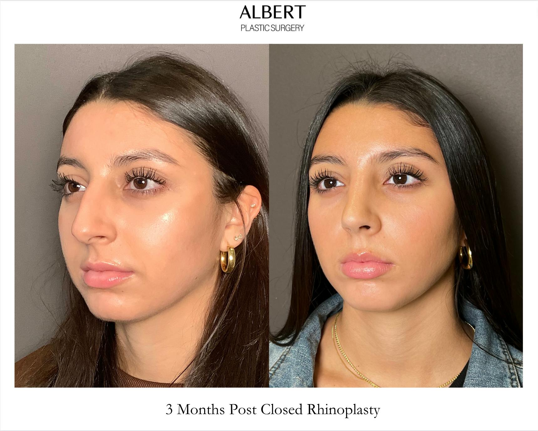 Rhinoplasty Before & After Gallery - Patient 393874 - Image 4