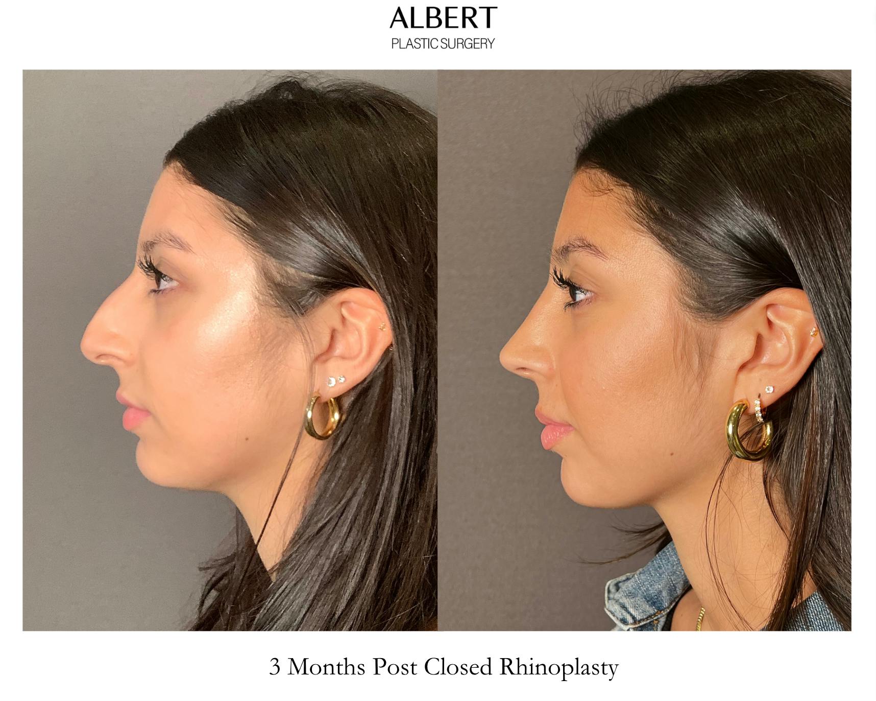 Rhinoplasty Before & After Gallery - Patient 393874 - Image 5